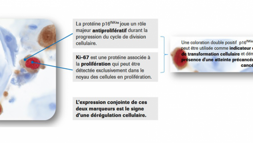 Dépistage du cancer du col de l'utérus : une vision plus claire ...