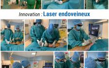laser endoveineux